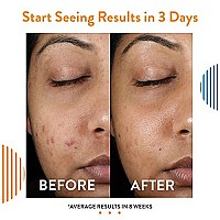 Acne Free 3 Step 24 Hour Acne Treatment Kit - Clearing System w Oil Free Acne Cleanser, Witch Hazel Toner, & Oil Free Acne Lotion - Acne Solution w/ Benzoyl Peroxide For Teens and Adults - Original