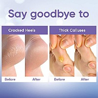 Foot Peel Mask 2 Pairs For Baby Soft Skin Remove Dead Skin Dry Cracked Feet Callus Spa Made With Aloe Vera Extract Wom