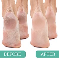 Maccibelle Salon Foot Pumice And Scrubber For Feet And Heels Callus And Dead Skins Safely And Easily Eliminate Callus And Rough