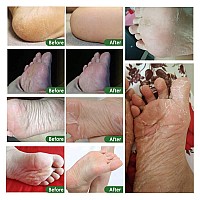 Foot Peel Mask 5Pack Exfoliating Foot Care Mask Make Soft Baby Feet Peel Foot Exfoliator Repair Dead Skin Calluses Chapped