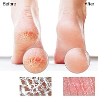 Sunivaca Glass Foot File Callus Remover For Feet Heel Scraper Pumice Stone Diabetic Feet Scrubber Dead Skin Remover For Feet