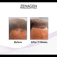 Zenagen Revolve Thickening Hair Loss Treatment For Men 16 Fl Oz