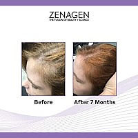 Zenagen Revolve Thickening Hair Loss Treatment For Women 16 Fl Oz