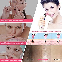 Blackhead Remover Pore Vacuum Face Suction Pore Cleanser 5 Suction Power Electric Blackhead Extractor Tool 4 Probes Blackhea