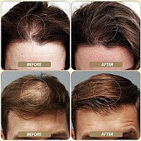 Sovoncare Hair Fibers For Thinning Hair Dark Brown Hair Building Fibers For Bald Spots Undetectable Natural Conceals Hair Lo