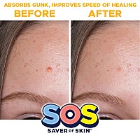 Sos Saver Of Skin Fun Shape Blemish Patches Fast Acting Hydrocolloid For Pimples Zits Acne And Face Blemishes Latexfree