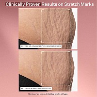 Strivectin Sd Advanced Plus Intensive Moisturizer For Wrinkles Stretchmarks For Face Body Collagen Boosting With Peptides