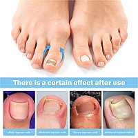 50 Pcs Breathable Corrector Patch Professional Pedicure For Ingrown Toenail Ingrown Toenail Corrector Patch 2 Pedicure Tools