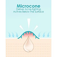 1Herolabs Microdart Acne Patch Hyaluronate Salicylic Acid Vitamin C Microdart Pimple Patch For Deep Early Stage And Hidde