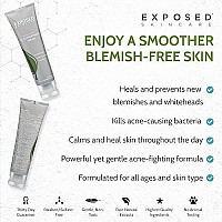 Exposed Skin Care Acne Treatment Serum Step 3 - Quickly Reduces Pimple Size and Redness - 12 Hour Spot Treatment - 3.5% Benzoyl Peroxide, Natural Green Tea & Tea Tree Oil