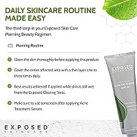 Exposed Skin Care Acne Treatment Serum Step 3 - Quickly Reduces Pimple Size and Redness - 12 Hour Spot Treatment - 3.5% Benzoyl Peroxide, Natural Green Tea & Tea Tree Oil