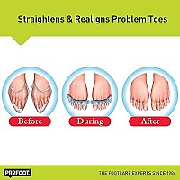 PROFOOT Flex-tastic Toe Spacers, Gel Toe Separators for Foot Pain, Bunions, Overlapping & Hammer Toes, Helps Restore Alignment & Circulation, Fits All, 1 Pair