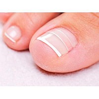 CurveCorrect Ingrown Toenail Home Treatment | Ingrown toenail Correction kit, Includes Ten Standard toenail Braces.