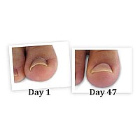 CurveCorrect Ingrown Toenail Home Treatment | Ingrown toenail Correction kit, Includes Ten Standard toenail Braces.