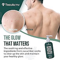 TreeActiv Acne Eliminating Body Lotion - Cucumber Mint Scent, 2% Salicylic Acid Moisturizer Lotion - Body Acne Treatment And Butt Acne Clearing Treatment for Women and Men, Non-GMO