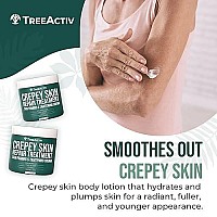 TreeActiv Crepey Skin Repair Treatment, 8oz, Firming Crepe Skin Cream with Hyaluronic Acid & Shea Butter to Deeply Moisturize & Tighten Wrinkly Dry Crepe Skin, 500+ Uses