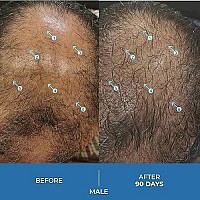 Spectraluhp Extra Strength Hair Growth Treatment With Minoxidil 5 3 Month Supply