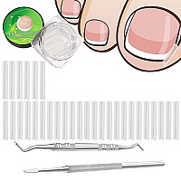 302 Pack Ingrown Toenail Correction Treatment Kit 30Pcs Ingrown Toenail Corrector Strips Brace Ingrown Toenail Pedicure Tool