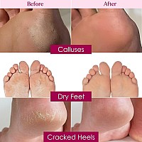 Foot Mask Spa Kit Pack Of 8 2X Foot Peeling Mask 6X Hydrating Foot Masks With Fuzzy Socks For Dry Cracked Heels Calluses